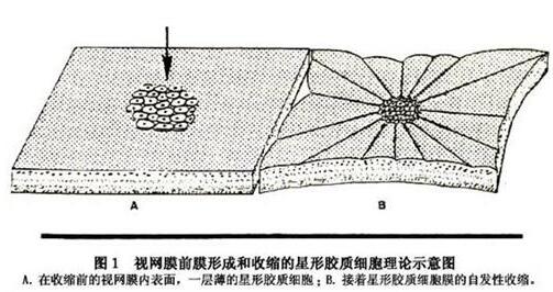 黄斑前膜