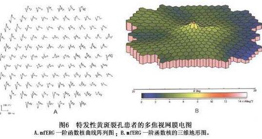 黄斑变性