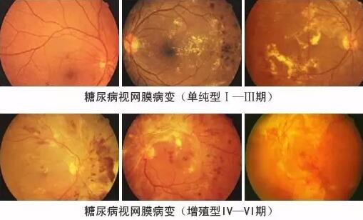 糖尿病引起的眼部并发症有很多，糖尿病视网膜病变(DR)就是其中之一，糖尿病视网膜病变是糖尿病在眼部的一种严重并发症，它对视力有很大危害，如不及时医治，可能造成失明。症状包括视力模糊、阴影、斑点及疼痛。.jpg