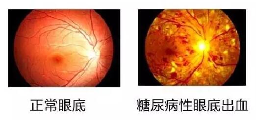  数据表明：糖尿病视网膜病变(简称糖网病)患病率达44%~51.3%，被世界卫生组织认为是仅次于白内障、青光眼的 三致盲眼病。但是不少尤其是基层糖尿病患者，大多数把眼睛的异变误认为是老年人眼花正常现象，从而耽误了病情甚至导致失明。.jpg