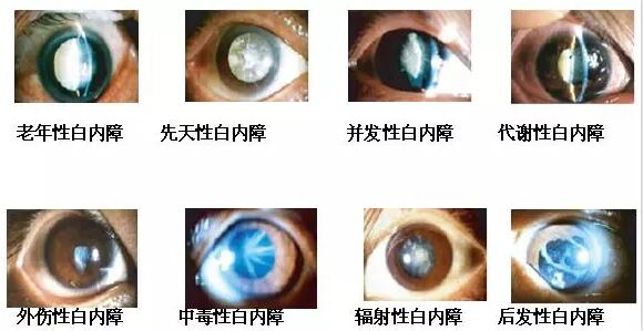 长时间在白色光亮污染环境下工作和生活的人，尤其是长时间接触过强的光线，视网膜和虹膜都会受到程度不同的损害，较终也会伤害晶状体，时间一长，就会使视力下降，使晶状体蛋白发生变性，形成混浊，发展成为白内障1.jpg