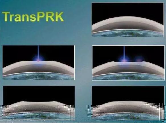 全激光TransPRK手术有其无可比拟的优势，但是 一的缺点就是属于表层手术，术后三天需要配戴隐形眼镜等待上皮愈合，在术后当天以及术后早期眼部会有较飞秒较重的不适感， 时间稍慢，一般需要一周到十天才能逐渐 .jpg