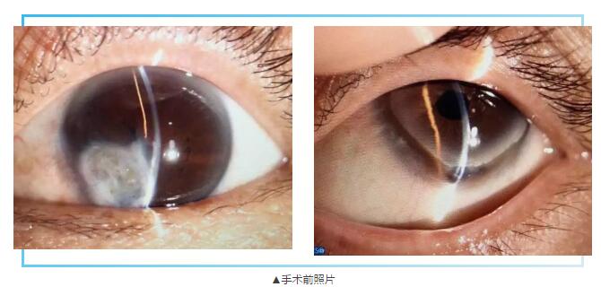 即便天气如此恶劣，合肥名人眼科医院的所有医护人员依然兢兢业业的守护在自己的岗位上。其中有两位患者分别来自安徽的蒙城和涡阳，一 角膜愈着性白斑，致虹膜前后黏连，视力仅有手动。另一 角膜严重边缘变性致穿孔，急需通过角膜移植手术保住眼球。2.jpg