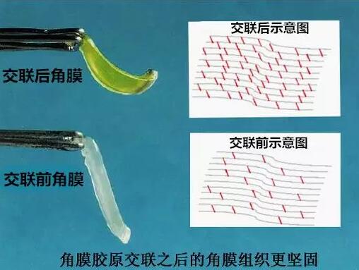 角膜胶原交联(Corneal Cross Linking，CCL)医治：使用370纳米波长的紫外线，激活核黄素(一种光敏感剂)，使其转化成活性氧族，活性氧族再诱导角膜胶原纤维的氨基之间发生化学交联反应，使角膜胶原纤维直径增粗、提*角膜基质对多种降解酶作用的抵抗力等多重生物学效应，从而使角膜基质的机械强度增加2.jpg