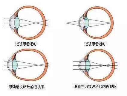 “小孩视力以前挺好的，没想到一个寒假下来就近视了。”昨天的华厦眼科医院小儿眼科门诊里，很多家长都反应说，“孩子期末成绩不错，所以假期里对他的管束放松了，一有空就拿起手机玩。直到前几天，他嚷着看东西变模糊了，才带孩子来医院检查，检查结果是左右眼出现不同程度的近视，医生建议配戴眼镜。.jpg