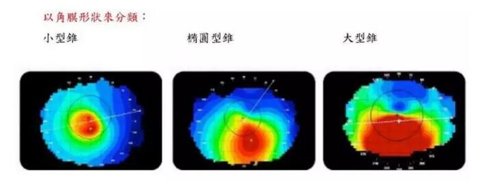 圆锥角膜是一种角膜扩张性疾病，患病后角膜中央或偏中央区域会发生局部变薄向外扩张，导致散光，并随着病情进展逐渐出现视力下降、 不良、视物扭曲变形、虹视等，极大影响生活，严重者可致盲。2.jpg