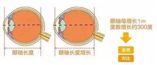 目前主流的摘镜方式有飞秒激光、准分子激光手术、ICL晶体植入术等近视手术方式，不论是高度近视、超高度近视、角膜偏薄患者、干眼患者， 检查合格，都有相应的近视手术 方案。.jpg