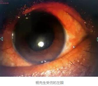 白内障和青光眼都是致盲性眼病，其中青光眼的病程不逆转。杨先生拖延伤情导致同时并发白内障、青光眼的情况，十分令人惋惜。”出名眼科专家、成都华厦眼科医院陈晓明教授表示2.jpg