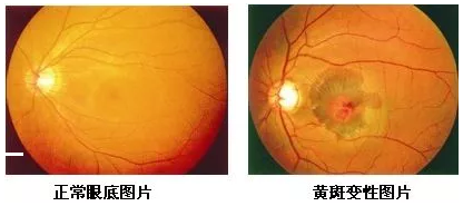 黄斑位于人眼底视网膜的中央，是视力 敏锐的部位，一般医生在测视力时，就是在检查黄斑区的视觉能力。当黄斑区出现异常时，也就是黄斑病变，人的中心视力就会变模糊、变扭曲。.png