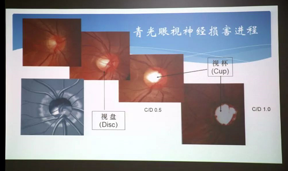 3月10日上午，深圳华厦眼科医院“早查监控，守护光明”大型青光眼公益科普讲座在六楼 举行，本次活动旨在让更多人了解青光眼的潜在危害、重视眼检查， 预防青光眼。由深圳华厦眼科医院青光眼病科 席专家成洪波博士、傅培副院长现场面对面解答疑问，与参会者的互动交流，让更多深圳市民提*对青光眼的认识与防治知识3.png