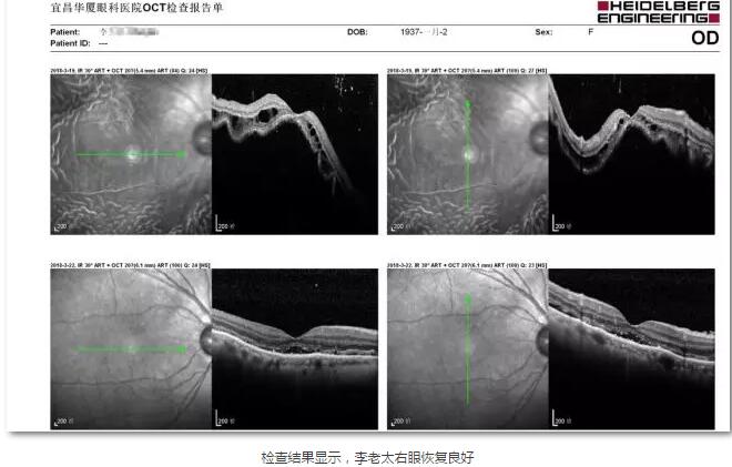 李老太在毫无征兆的情况下右眼视力下降至看不见东西。李老太家人带其至县医院就诊。医生诊断为视网膜脱离，需做玻切手术医治，而玻切手术需要动手术2次。怕疼的李老太一听就犯怵了：开刀，疼。 终，李老太的家人在多方打听后决定带李老太至宜昌华厦眼科医院找许大玲院长医治4.jpg