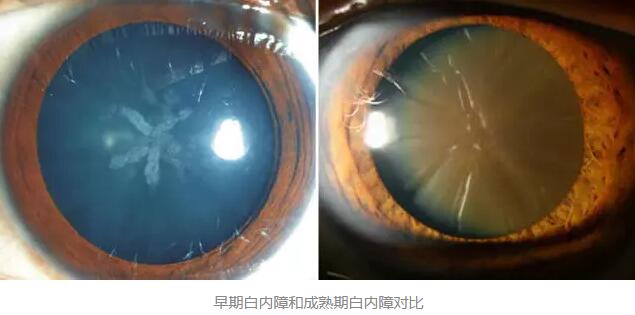 白内障超声乳化术是如今新式微创白内障手术，它创伤小、愈合快，术后 二天 正常生活。老年人能不能承受得住白内障手术呢2.jpg