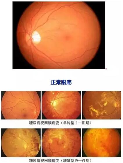 4月14日(本周六)福州眼科医院将举办“常见老年人眼底病”公益讲座，由医院副院长、眼底病科何建忠主任主讲，为大家解读各类眼底疾病的预防和诊治知识1.jpg