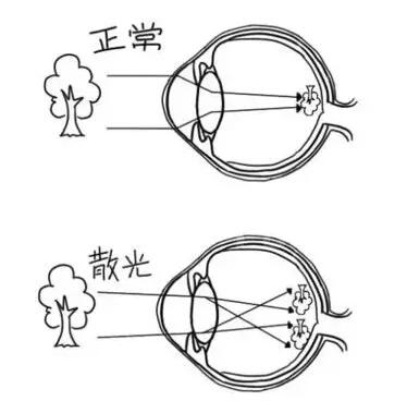 近视加散光想要 ，飞秒全激光近视手术是很好的选择。 一*次近视激光手术，就可以同时 近视、合并散光。1.jpg