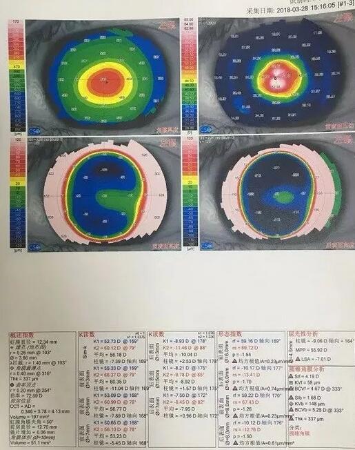 角膜移植是利用异体的正常透明角膜组织，取代浑浊病变的角膜组织，使患者复明或控制角膜病变，这在目前同种器官移植当中， 率是 高的，也是重要的复明手术之一。”在 为一位饱受圆锥角膜之苦患者 实施角膜移植之后，卢敏院长也对患者极为关心的角膜移植相关知识进行介绍。比如哪些患者适合角膜移植手术