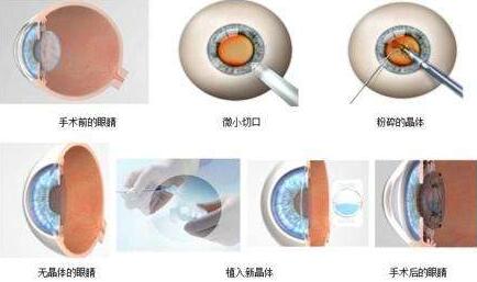 三焦点人工晶体手术原理：置换掉人眼老去的晶体，世代的晶体不仅有非常好的弹性，以往传统的白内障手术只是单纯的脱盲复明手术，更多的是解决患者 远视力。而三焦点人工晶体的问世，彻*解决了传统白内障术后仍需配镜的问题，实现了从以往‘看得见’到‘看得清、看得好’的转变.jpg
