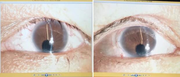 先天性虹膜脉络膜缺损的白内障患者在厦门眼科中心白内障超乳手术后视觉满意2.jpg