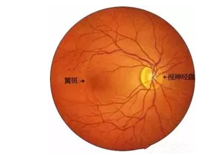 老年黄斑变性其实是眼部黄斑区结构的衰老性改变引起的眼病。“黄斑”是位于视网膜核心区的一个生理结构，一旦黄斑区的视神经细胞被破坏，就会引起患者中心视力下降、视物变形、色暗等1.png