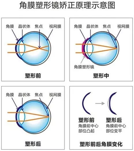 角膜塑形镜是一种硬性透气性隐形眼镜，戴在眼表可使角膜发生塑形效应，从而达到 近视度数的 。适合夜晚睡觉时配戴，白天不用戴眼镜就可以 裸眼视力，不影响学习、运动.png