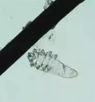 眼部瘙痒、干涩泛红、异物感，可能不是干眼症而是蠕形螨性睑缘炎.png