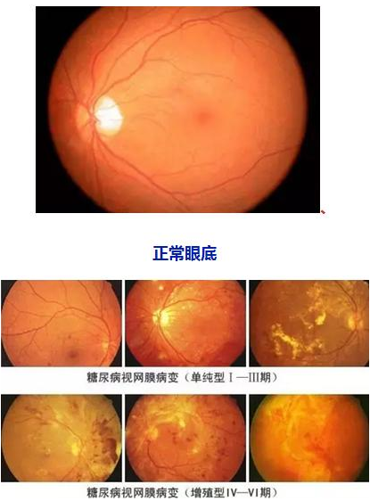 糖网病的症状和防治方式.png