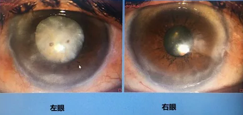 同时患 青光眼、白内障老婆婆辗转几家医院之后终于在成都华厦眼科顺利手术2.png