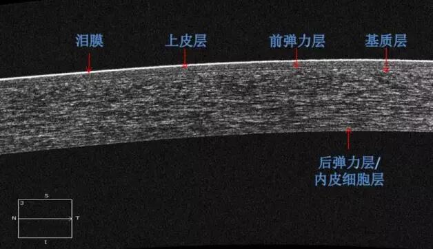 华厦眼科课堂：后节频域OCT前节模块的运用2.jpg