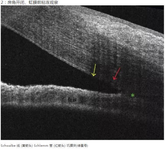 华厦眼科课堂：后节频域OCT前节模块的运用12.jpg