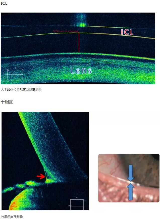 华厦眼科课堂：后节频域OCT前节模块的运用15.jpg