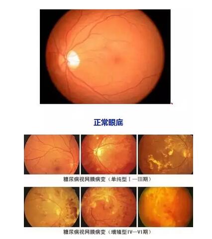 因糖网病几近失明在福州眼科医院进行微创玻切、白内障超乳术后顺利复明2.jpg