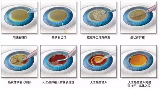 叶院长哪一种白内障手术 ，术后视觉 更好？.jpg