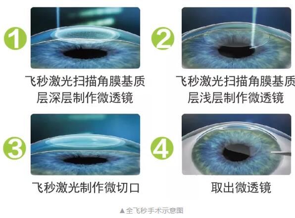 主流近视手术包含全飞秒激光手术、Smart全激光手术、半飞秒激光手术、晶体植入手术1.jpg