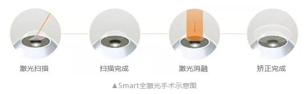 主流近视手术包含全飞秒激光手术、Smart全激光手术、半飞秒激光手术、晶体植入手术2.jpg