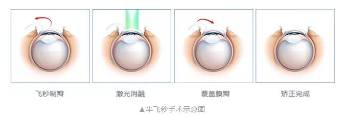 主流近视手术包含全飞秒激光手术、Smart全激光手术、半飞秒激光手术、晶体植入手术3.jpg