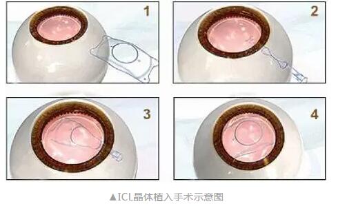 主流近视手术包含全飞秒激光手术、Smart全激光手术、半飞秒激光手术、晶体植入手术4.jpg