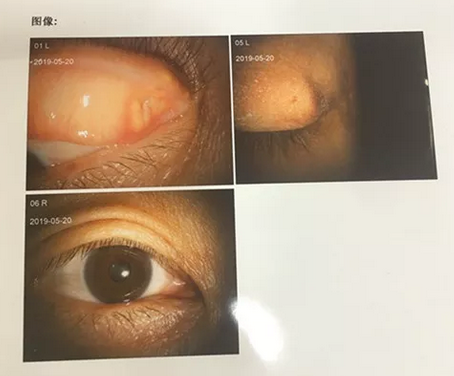 成都华厦眼科罗清礼院长为四处求医未果的河南眼眶肿瘤患者手术2.png