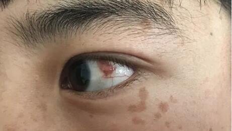 四川丹巴15岁男孩患结膜血管瘤，在成都华厦眼科医院顺利手术1.jpg