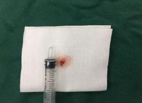 四川丹巴15岁男孩患结膜血管瘤，在成都华厦眼科医院顺利手术3.jpg