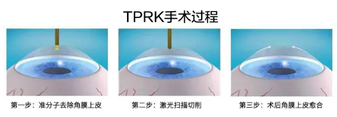 2021年征兵时间已定，参加征兵近视青年需尽快做近视手术3.png