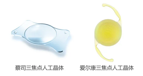我看到了9个月亮，中国医生一招解决！“洋女婿”患白内障几近失明，在厦门眼科中心手术4.png